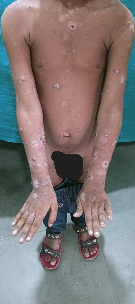 Allergic Dermatitis
